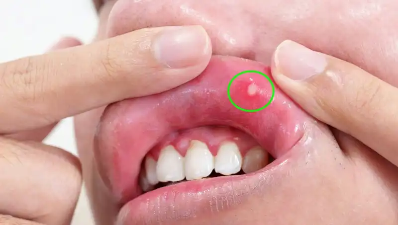 B Vitamini Eksikliği: Belirtileri ve Sağlık Üzerindeki Etkileri