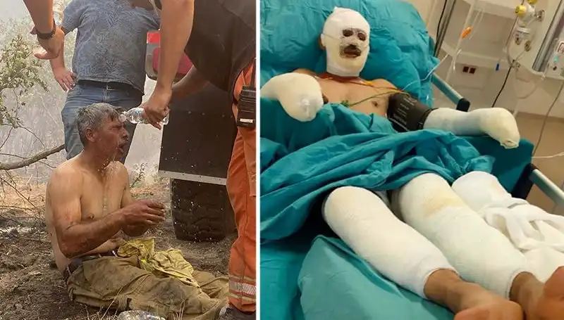 Orman İşçisinin Yanık Tedavisi Devam Ediyor: 'Yanıyorum' Feryadı Unutulmaz