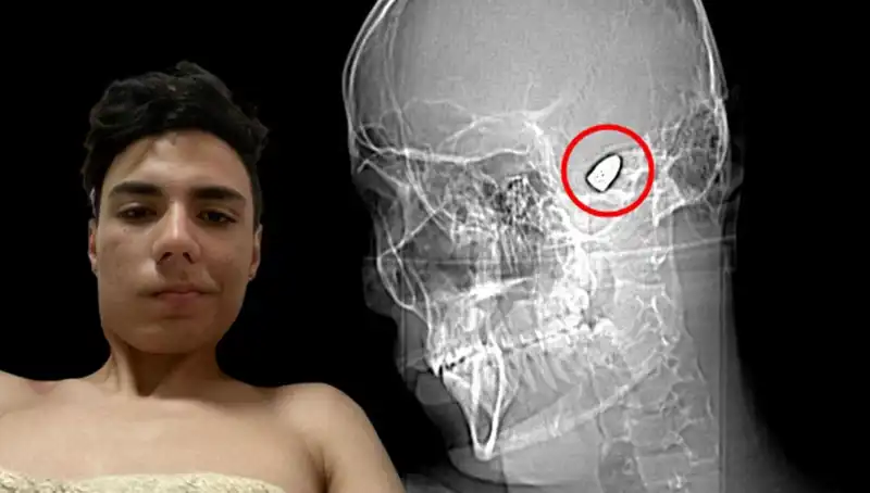 Kafasında Patlayıcıyla Gezen Adam, Hayat Mücadelesini Paylaştı