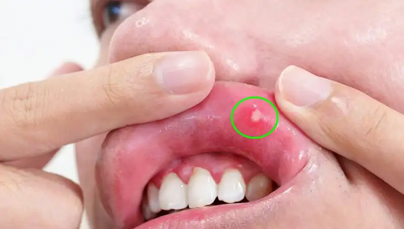 Kanserin İhmal Edilen Belirtileri: Dilini Kaybeden Kadının Hikayesi